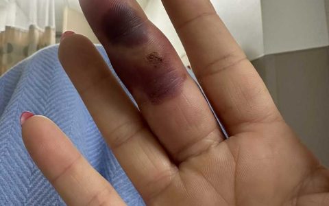 前WWE明星拉娜手指感染后续，手术后发布触目惊心的照片