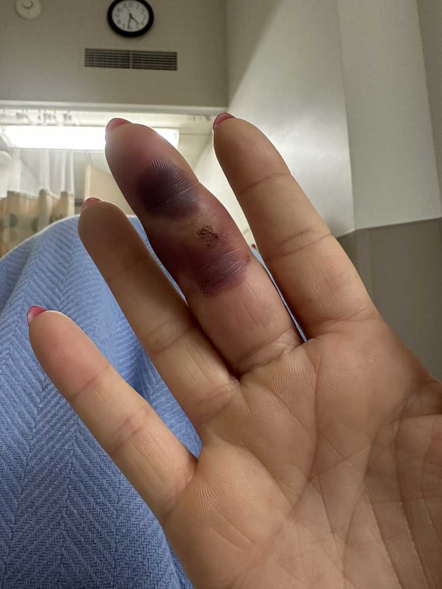 前WWE明星拉娜手指感染后续，手术后发布触目惊心的照片