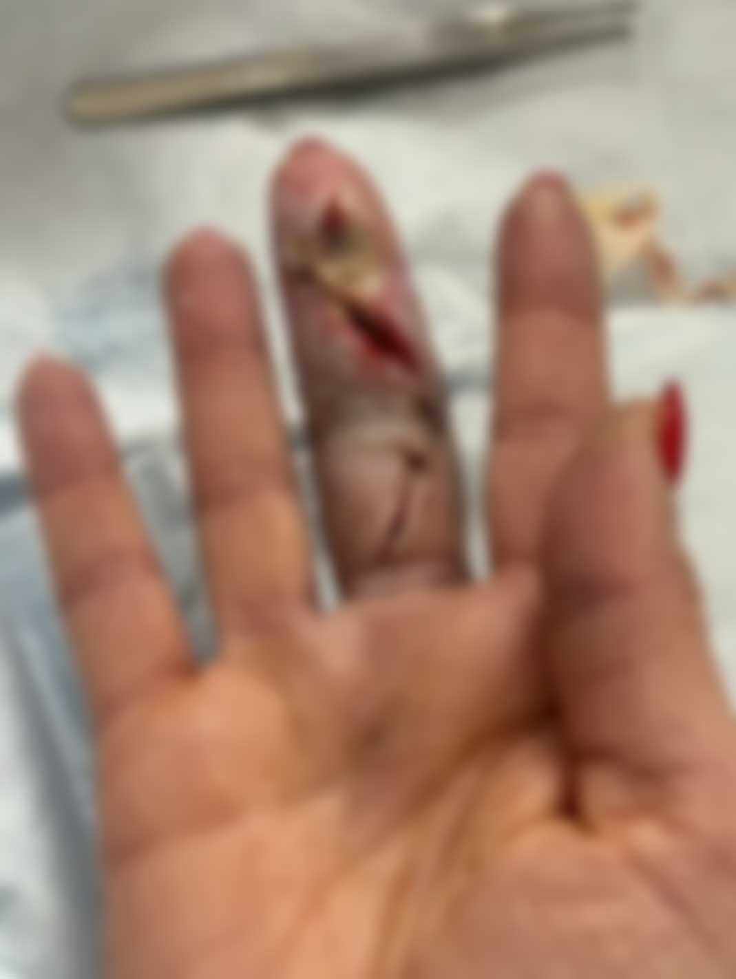 AEW明星CJ Perry因手指感染可能需再次手术